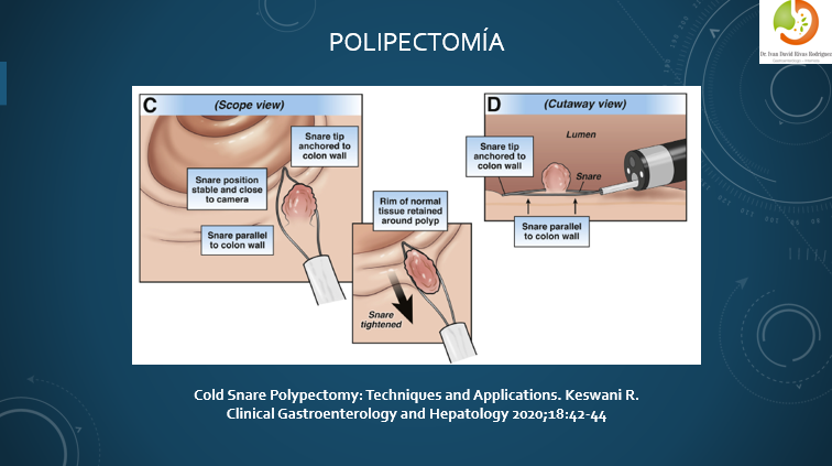 Polipectomía