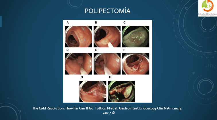 Polipectomía