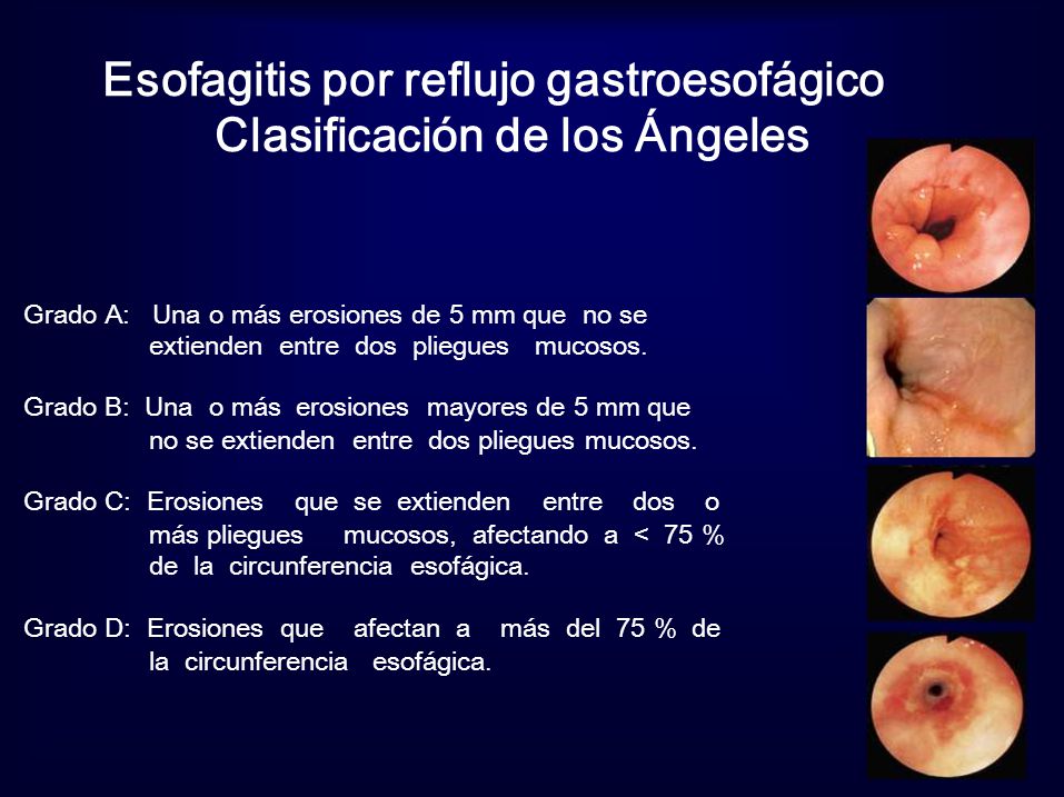 Clasificación de los Angeles para Esofagitis por Reflujo