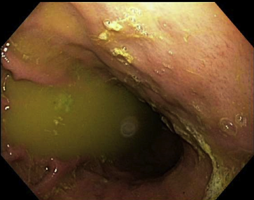 Gastritis Biliar