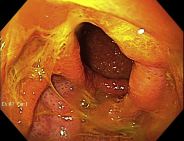 Gastritis Biliar