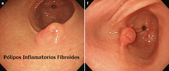 Pólipos Fibroides