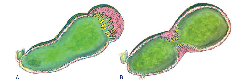 Adenomiomatosis segmentaria