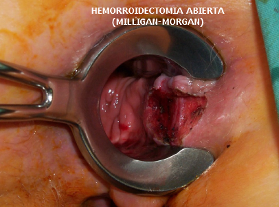 Hemorroidectomia 