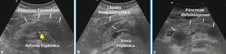 Pancreatitis aguda con líquido peripancreático