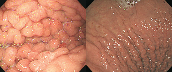 Gastritis Hipertrófica 
