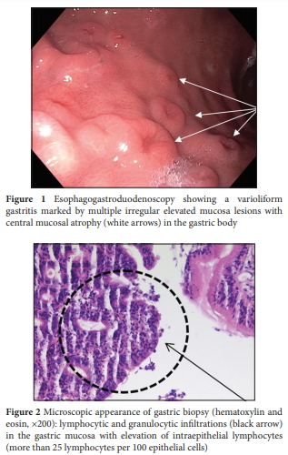 Gastritis Linfocítica 