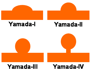 Clasificación de Yamada