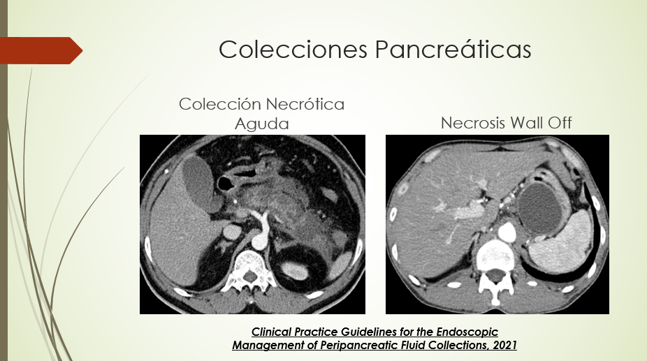 Colecciones Pancreáticas (continuación)