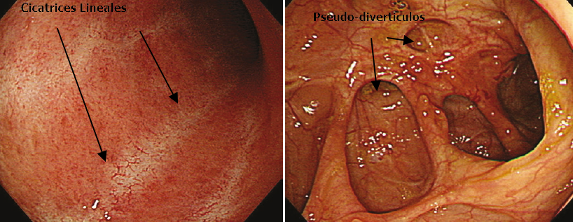 Colitis inactiva con pseudodivertículos