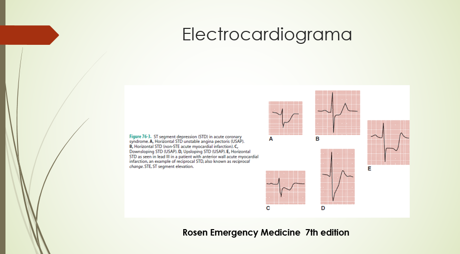 Electrocardiograma depresión ST (7)