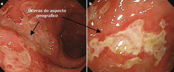 Enfermedad de Crohn úlceras de aspecto geográfico
