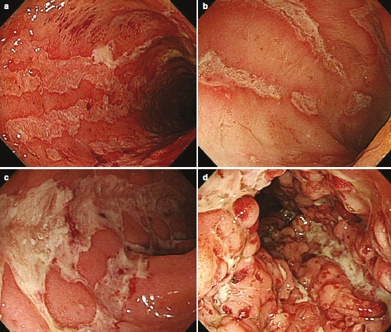 Enfermedad de Crohn úlceras longitudinales