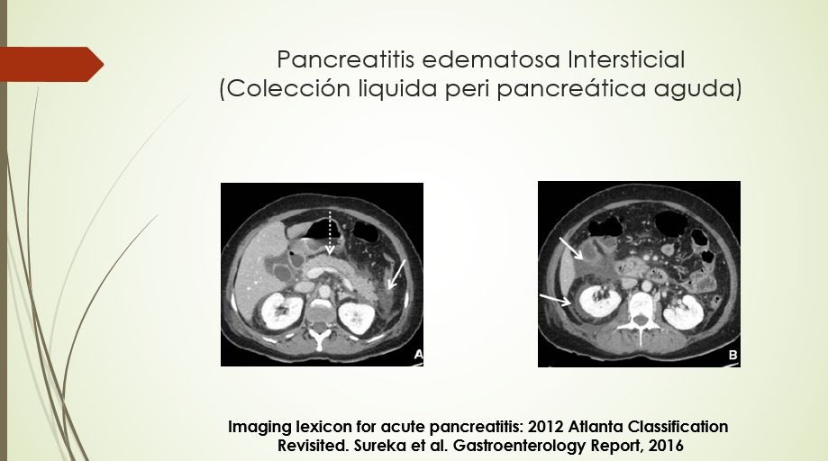 Pancreatitis edematosa Intersticial (continuación)