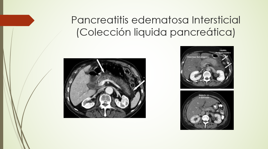 Pancreatitis edematosa Intersticial