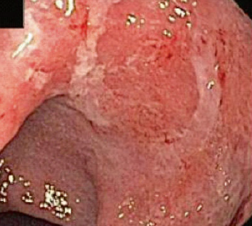 Rectocolitis ulcerativa leve con mucosa friable