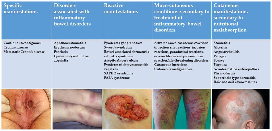 Dermatological Manifestations in Inflammatory Bowel Diseases