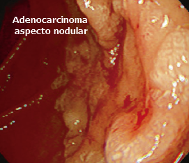 Adenocarcinoma de aspecto nodular