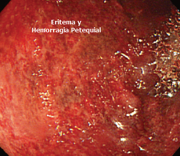 Colitis Isquémica con Hemorragia Petequial