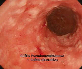 Colitis Pseudomembranosa y Colitis Ulcerosa