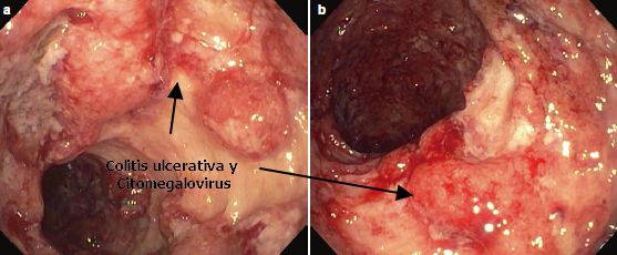 Colitis Ulcerativa y Citomegalovirus