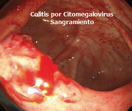 Colitis por Citomegalovirus sangramiento