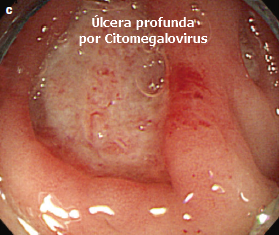 Colitis por Citomegalovirus úlcera profunda