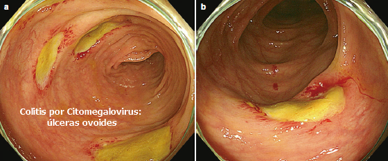 Colitis por Citomegalovirus úlceras ovoides