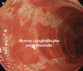 Colitis por Salmonella (Úlceras longitudinales)