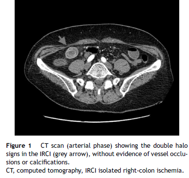 Hallazgos tomográficos de la colitis isquémica