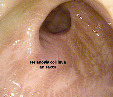 Melanosis coli