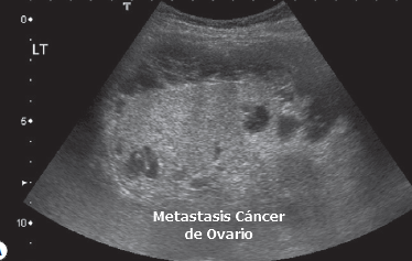 Metastasis de Cancer de Ovario