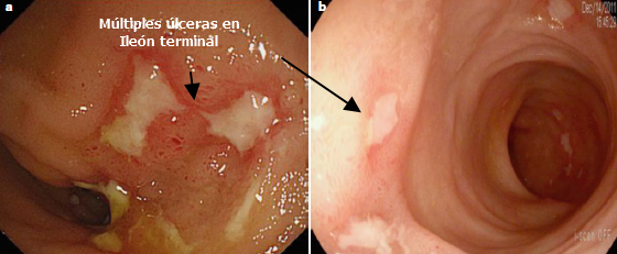 Múltiples úlceras en Íleon terminal