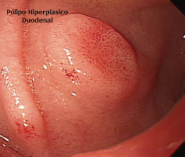 Pólipo Hiperplásico Duodenal