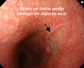 Úlcera esofágica