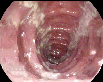 Ulceraciones lineales en colitis isquémica