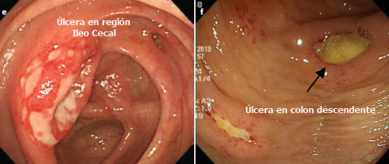 Úlceras en enfermedad de Behcet