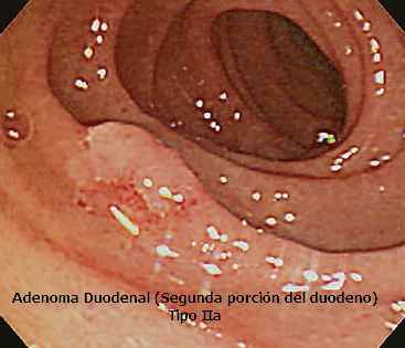 Adenoma Duodenal Tipo IIa