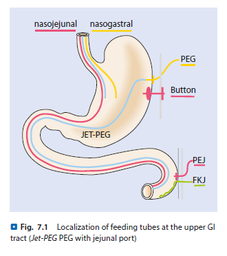 Localización de las Sondas en el tracto digestivo superior