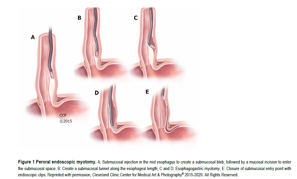 Miotomía peroral endoscópica (POEM)