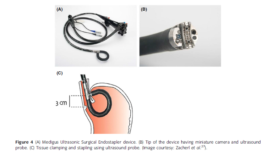 Medigus Ultrasonic Surgical Endostapler (MUSE)
