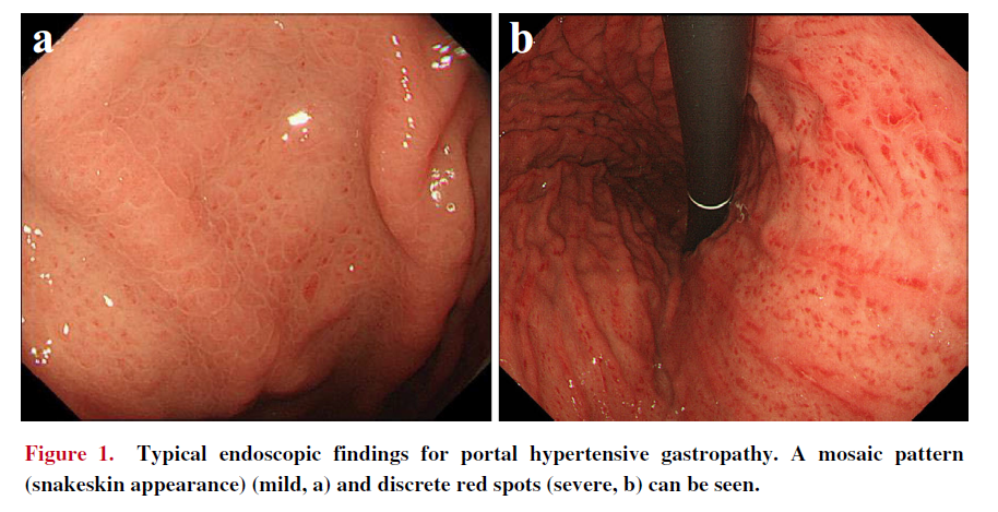 Hallazgos endoscópicos de gastropatía hipertensiva leve y severa