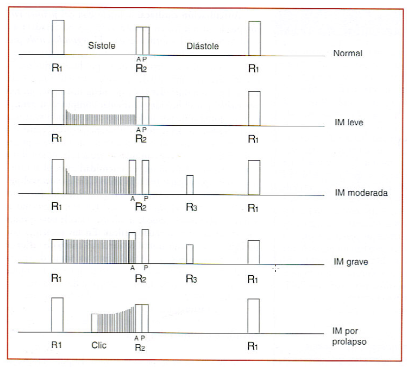 Soplos sistólicos – Gastro Mérida