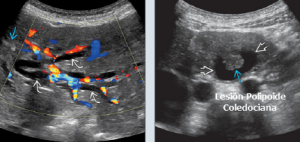 Ultrasonido de la Vesícula y el Árbol Biliar – Gastro Mérida