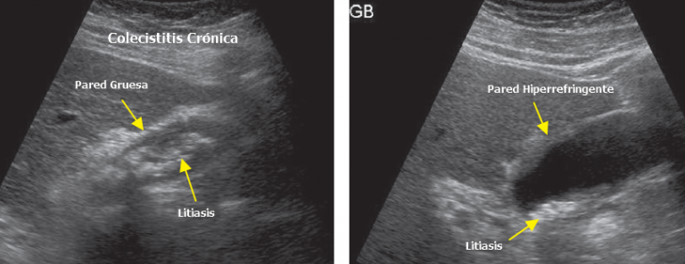 Ultrasonido de la Vesícula y el Árbol Biliar – Gastro Mérida