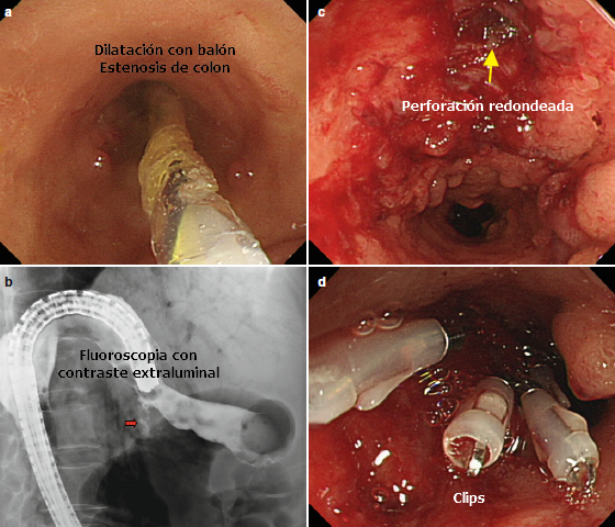 Perforación de Colon