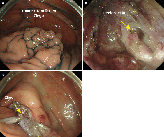 Perforación de Colon
