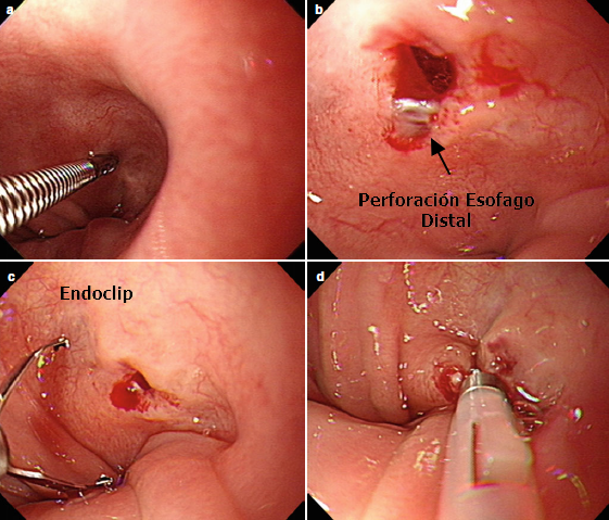 Perforación de Esofago