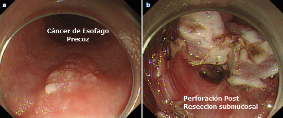 Perforación de Esofago