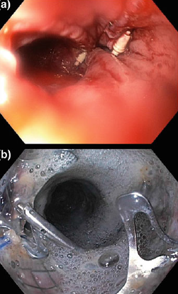 Perforación de Esofago